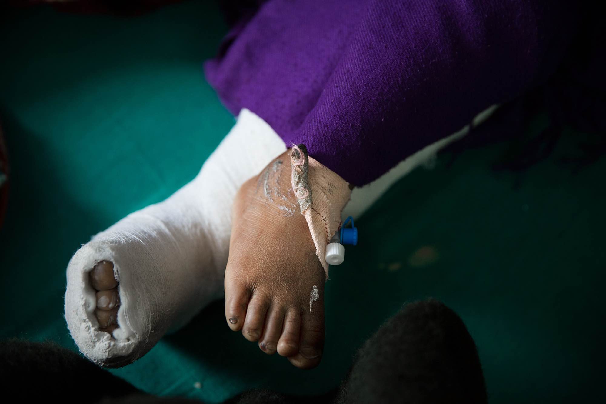 A young girl lays on her bed in a hospital's trauma ward after breaking her leg during the earthquake in Kathmandu, Nepal.